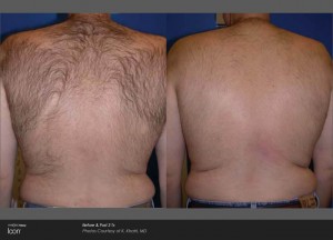 IconHairRemoval_back