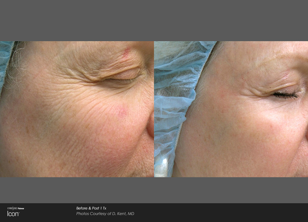 icon before skin laser wrinkle ipl treatment resurfacing wrinkles san rejuvenation smartskin spa erbium fractional photofacials fl ocala revitalization reduction